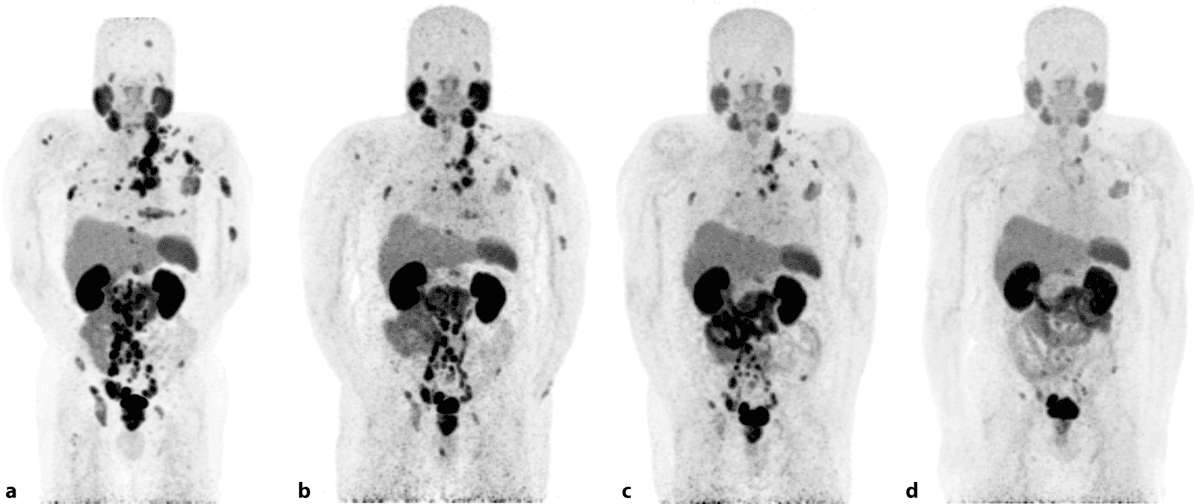 Lutetium treatment of prostate cancer medical condition