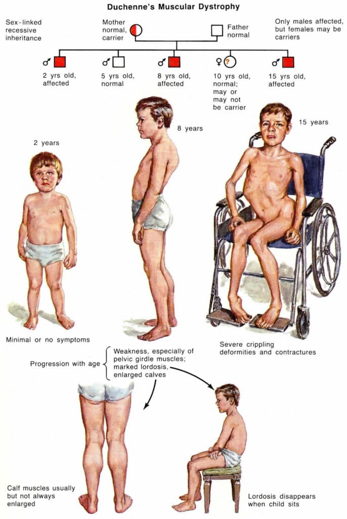 Muscular Dystrophy medical condition