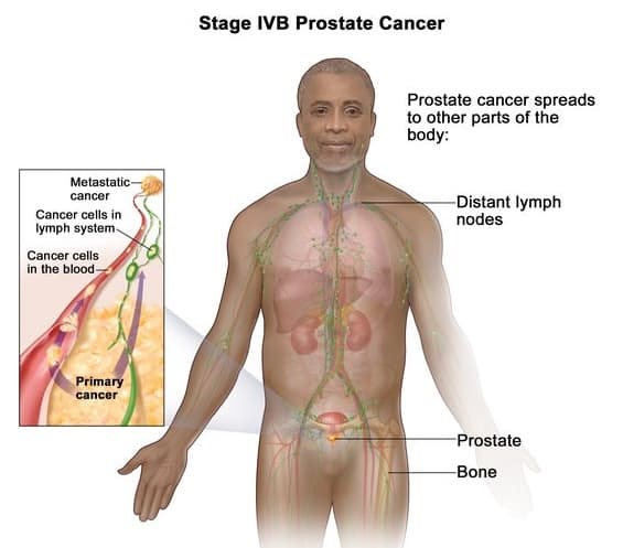 Metastatic prostate cancer medical condition