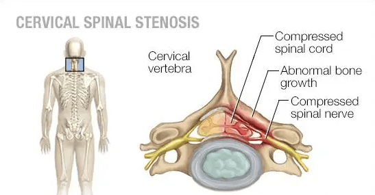Cervical stenosis medical condition