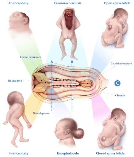 Congenital Anomalies medical condition