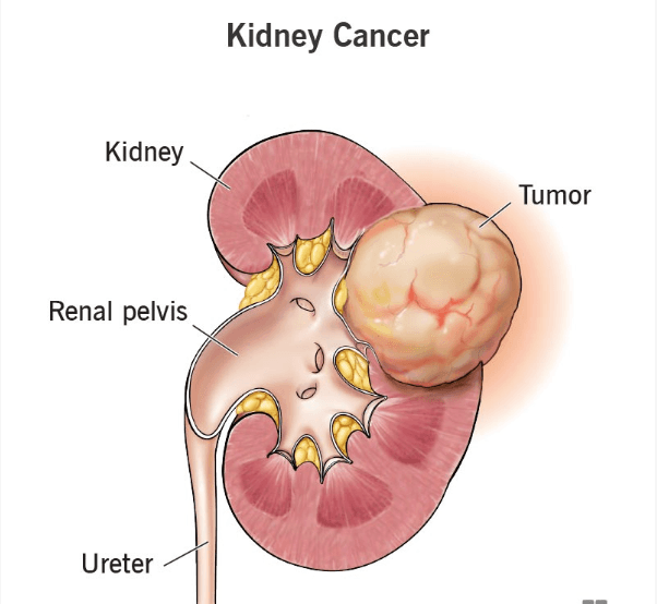 Kidney Cancer medical condition