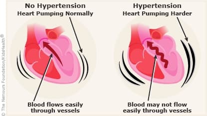 Hypertension (High Blood Pressure) medical condition