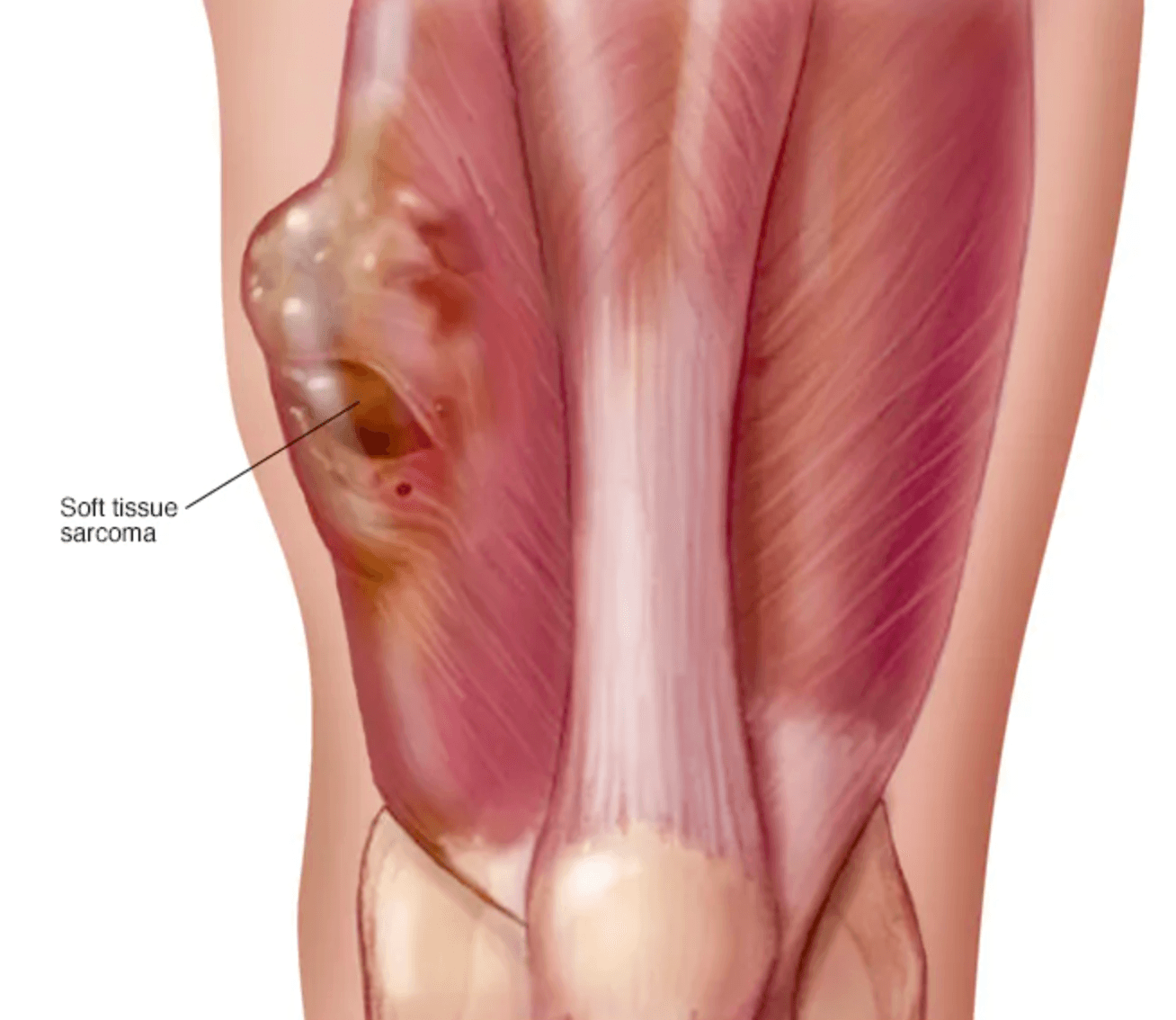 Soft tissue sarcoma medical condition