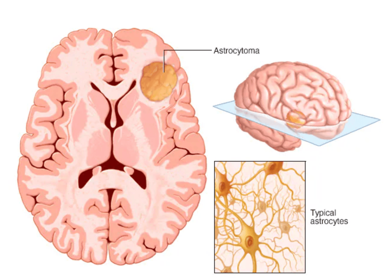 Astrocytoma medical condition