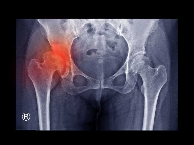 Hip Impingement Syndrome medical condition