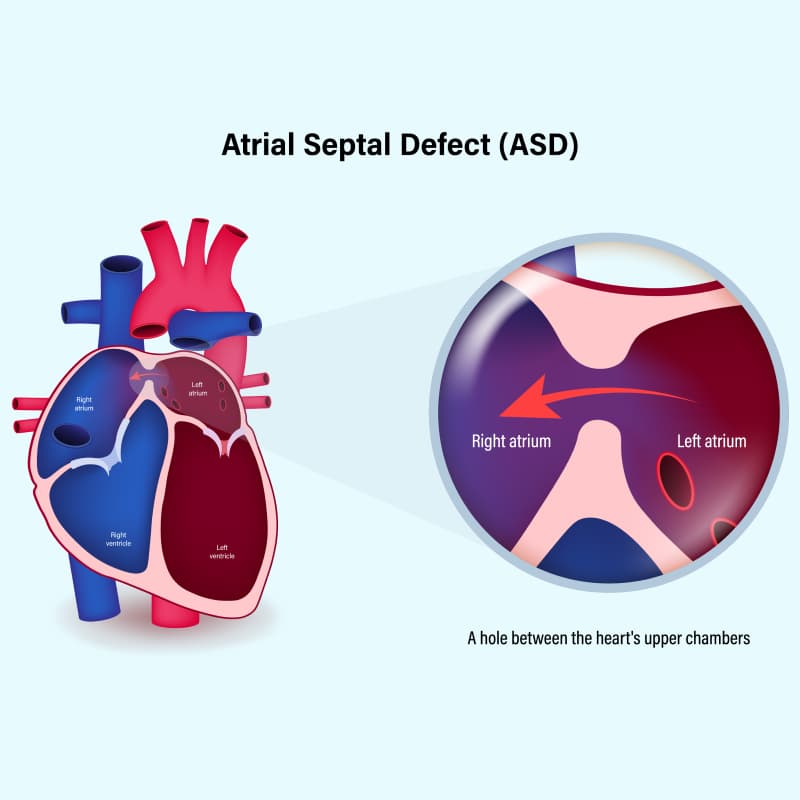 Closure of atrial septal defects medical condition
