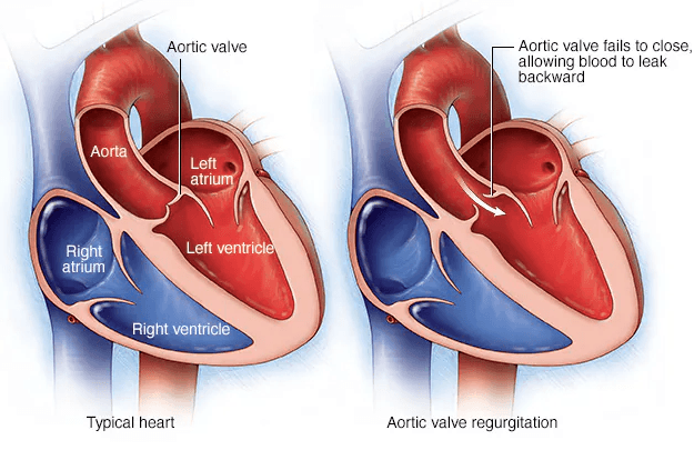 Aortic Valve Insufficiency (avi) medical condition