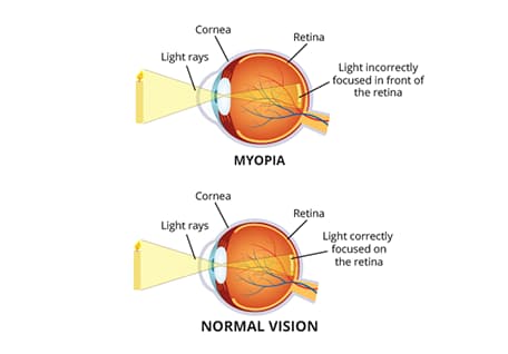 Myopia medical condition