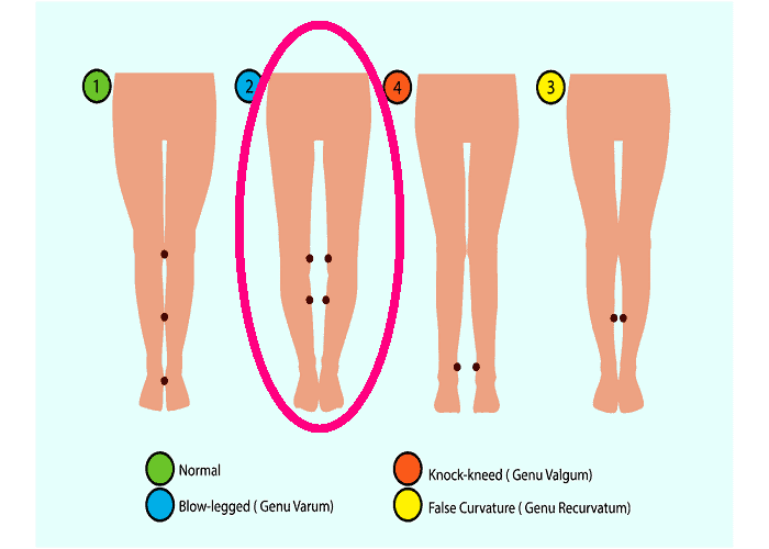 Bowed Legs medical condition