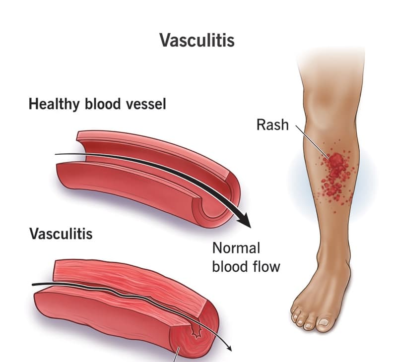 Vasculitis medical condition