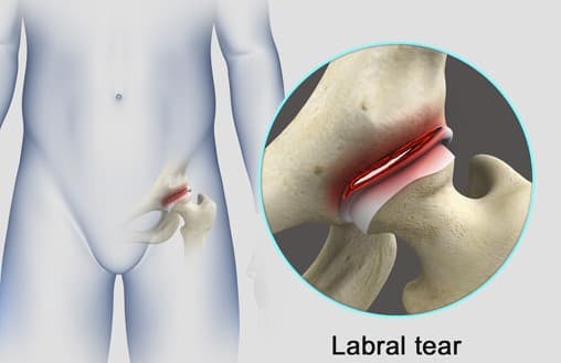 Hip Labral Tears medical condition