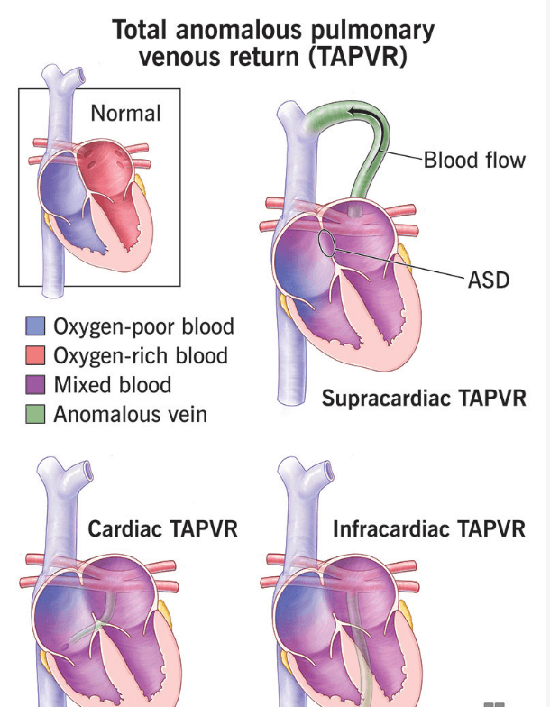 Anomalous Pulmonary Venous Connection medical condition