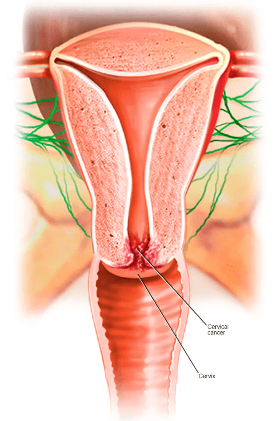 Cervical Cancer medical condition