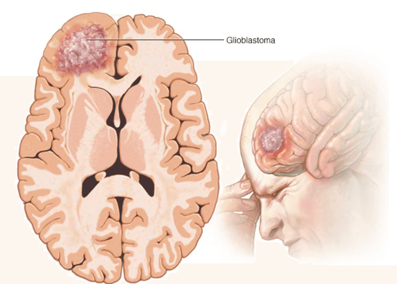 Glioblastoma medical condition