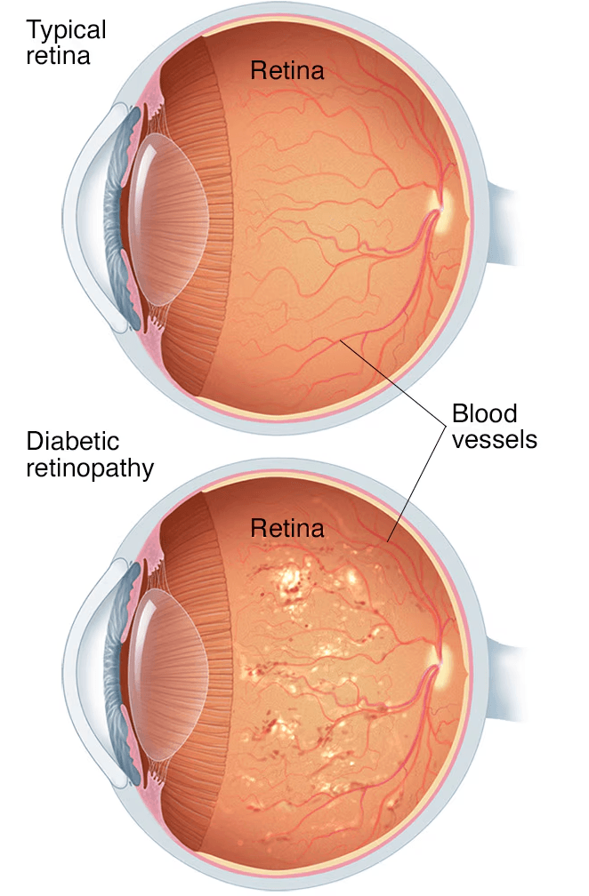 Diabetic retinopathy medical condition