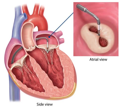 Mitral valve repair with Mitraclip medical condition
