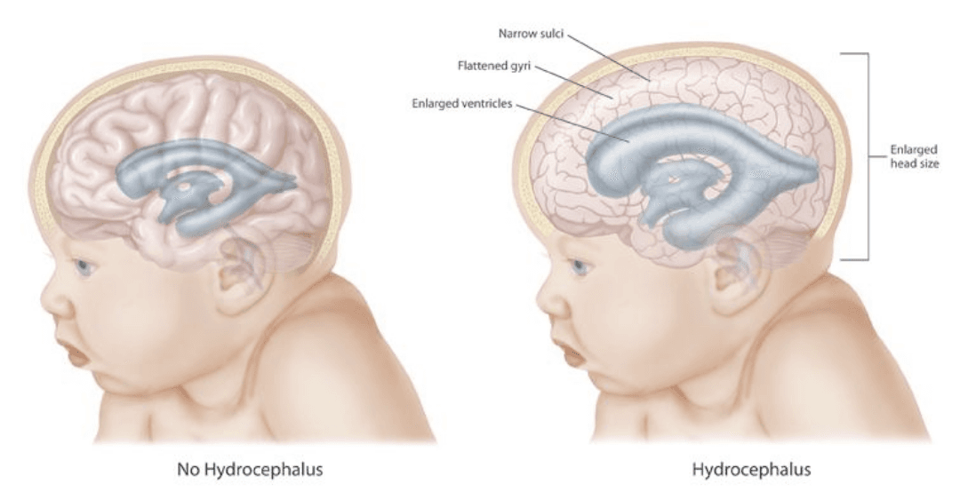 Hydrocephalus medical condition