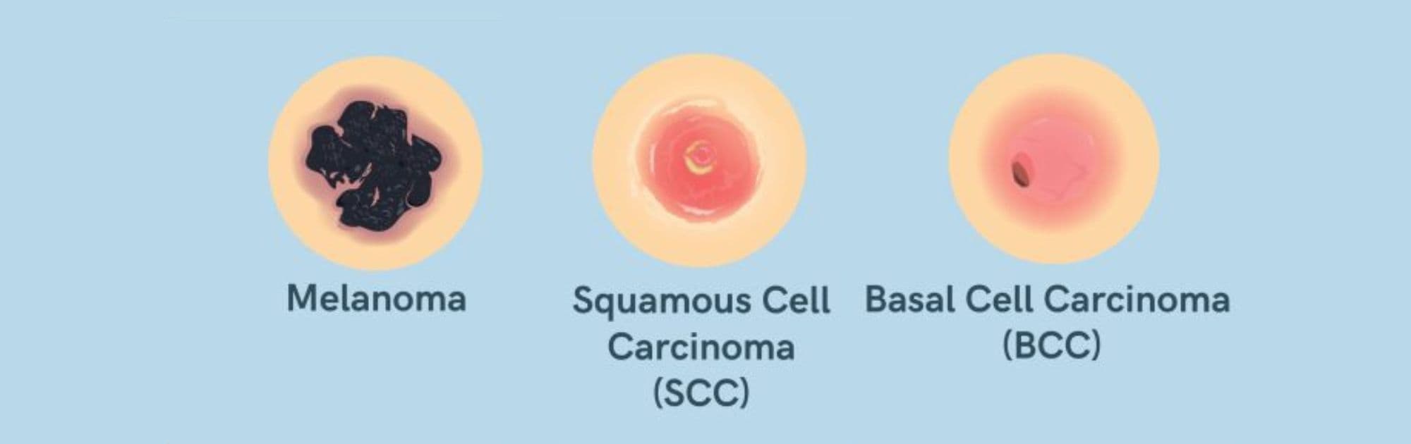 Skin Cancer (Melanoma and Non-Melanoma) medical condition