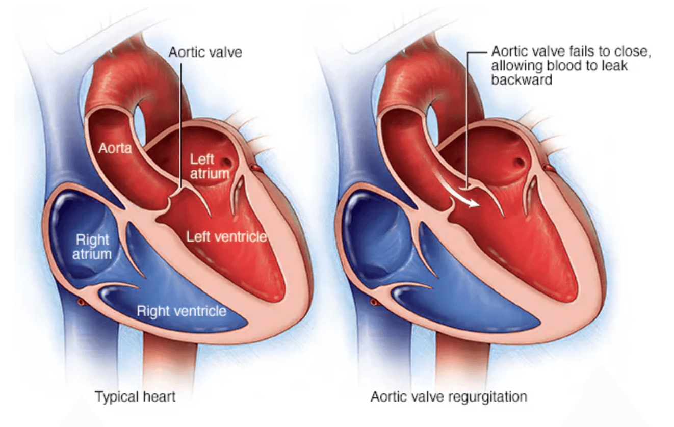 Aortic valve replacement medical condition