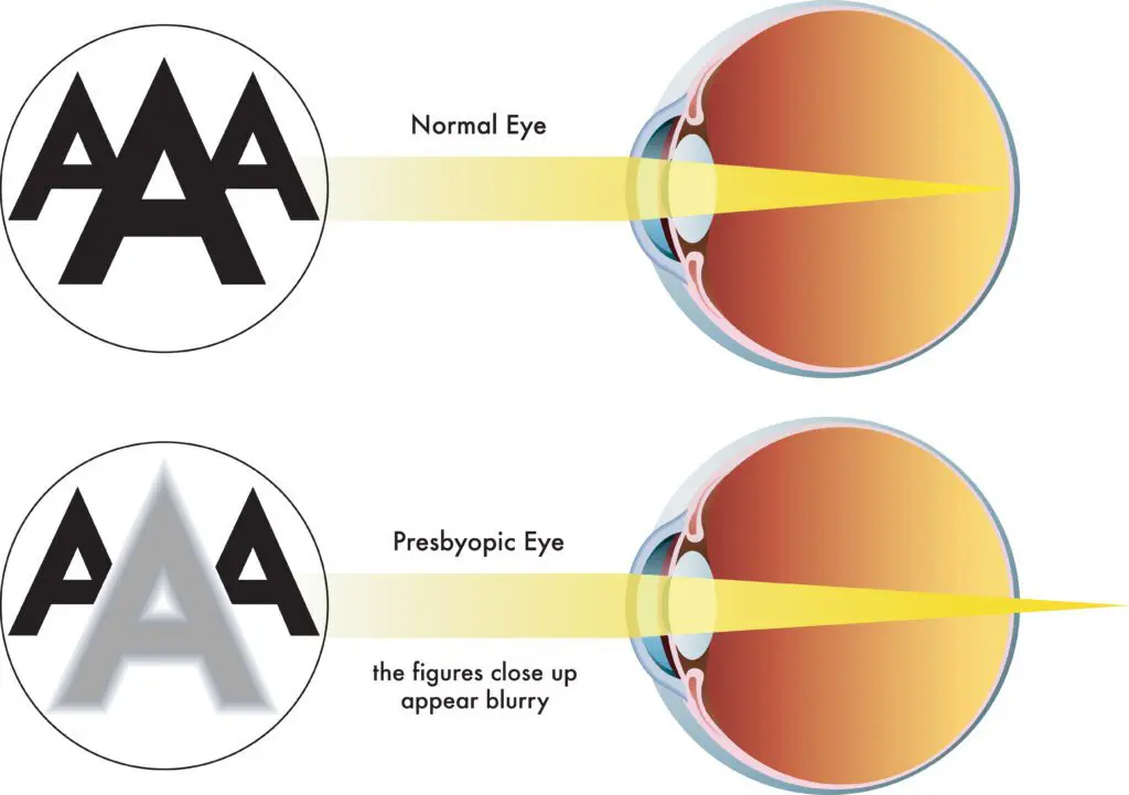 Presbyopia medical condition