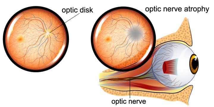 Optic nerve atrophy medical condition