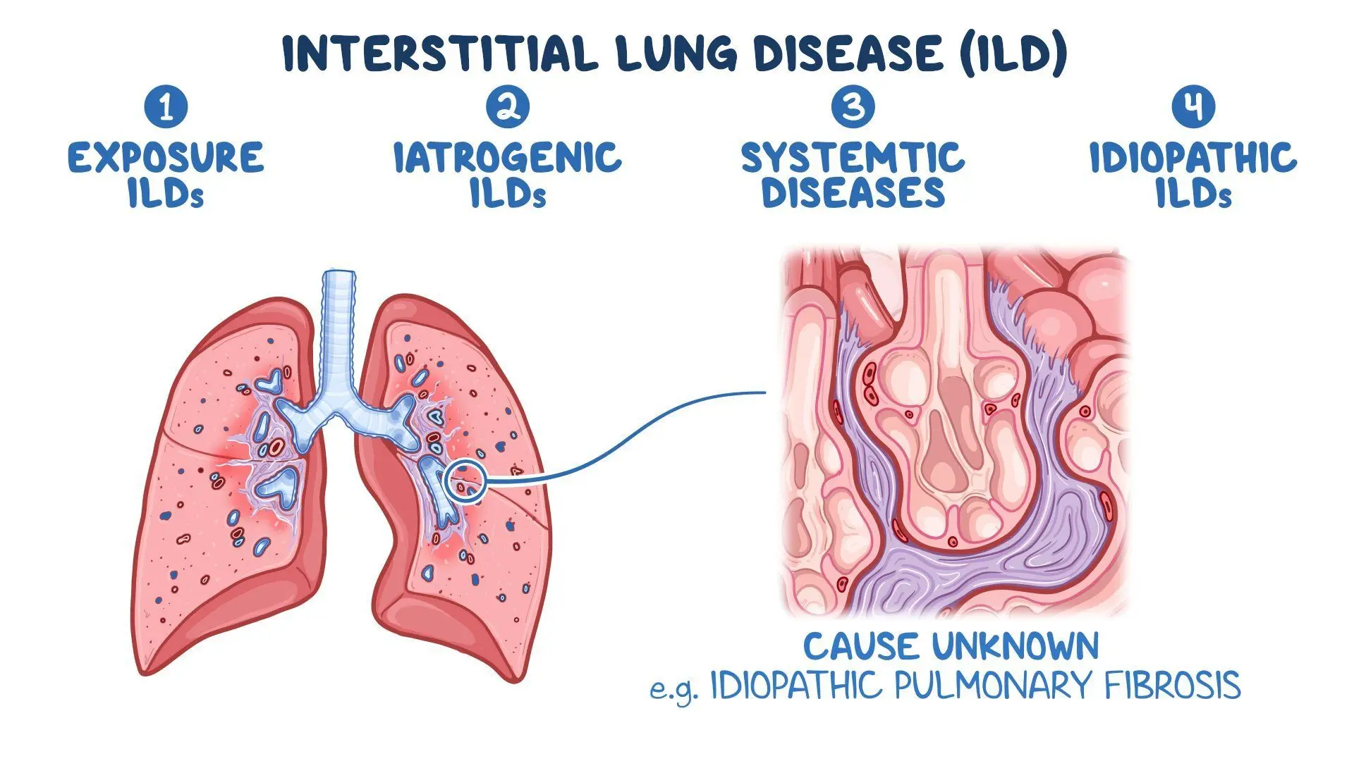 Interstitial Lung Diseases medical condition