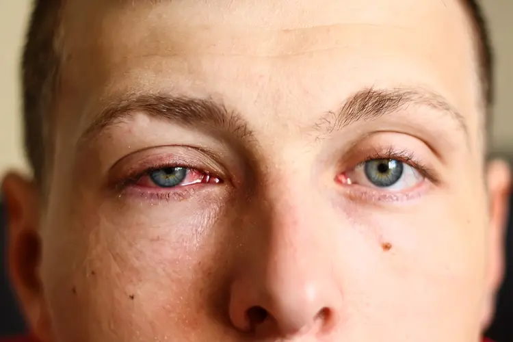 Conjunctivitis medical condition