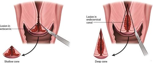 Сervix Conization medical condition