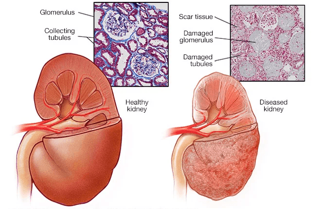 Chronic Kidney Disease medical condition