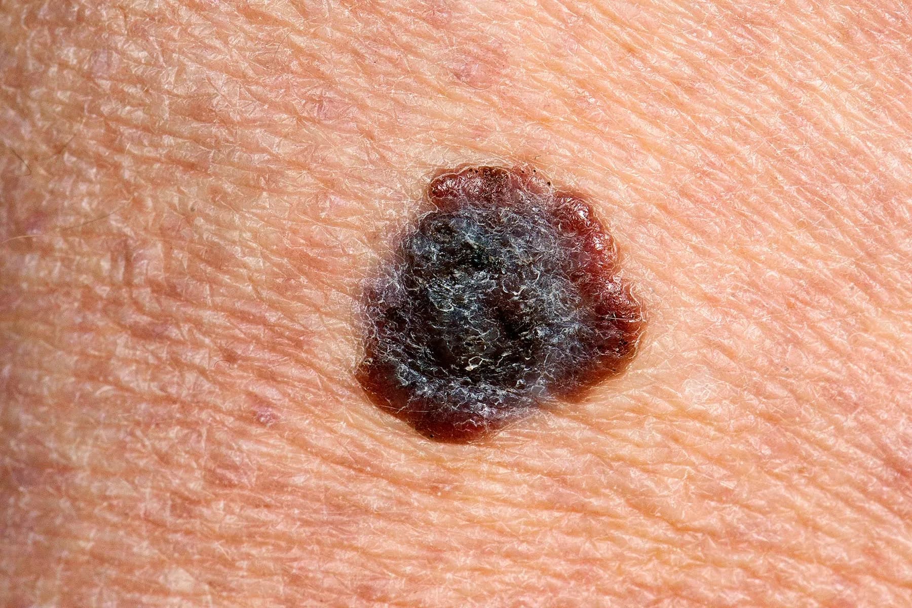Metastatic melanoma medical condition