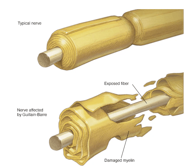 Guillain–Barré syndrome medical condition
