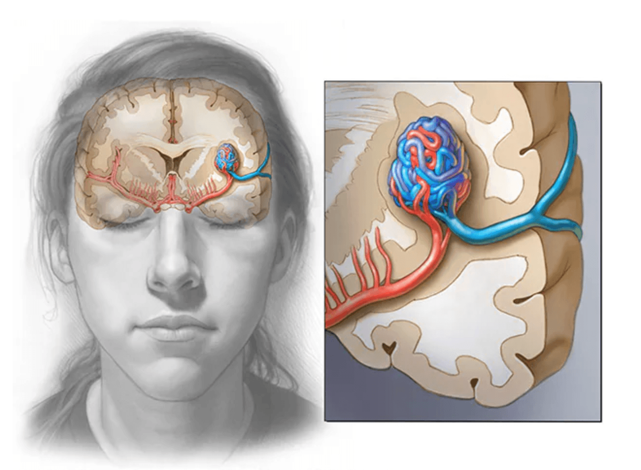 arteriovenous malformation (AVM) medical condition