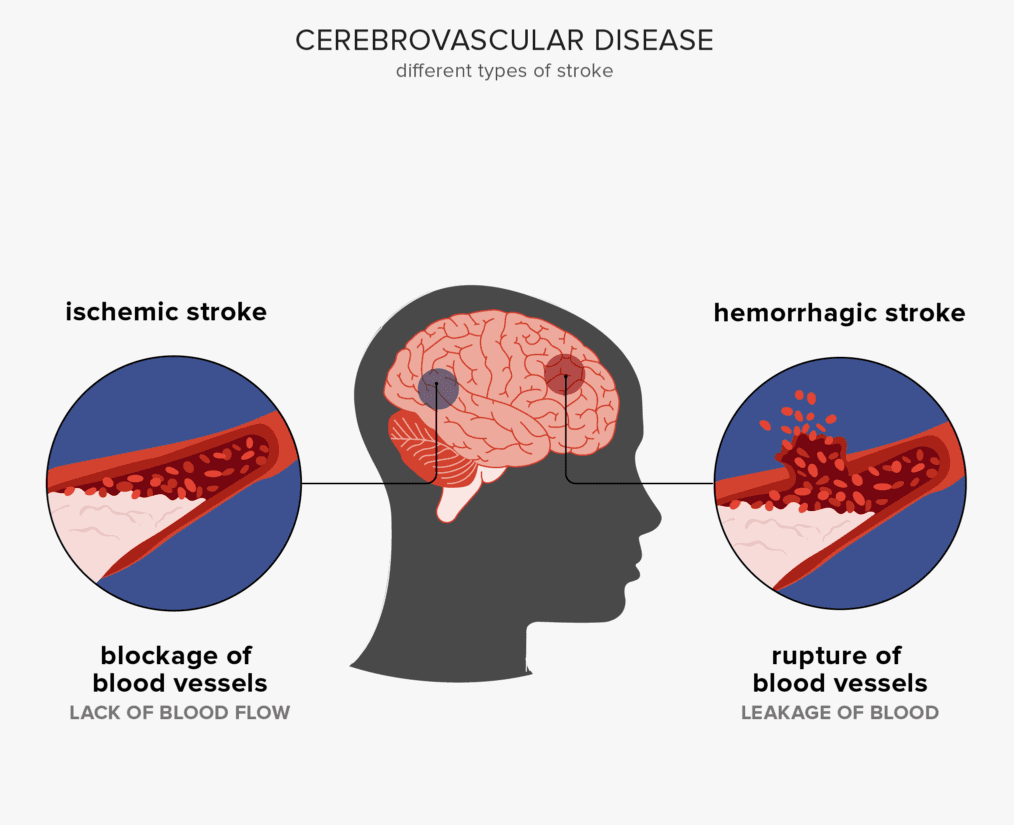 Cerebrovascular Diseases medical condition