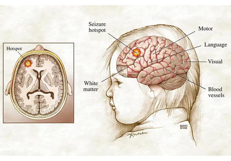Pediatric Epilepsy medical condition