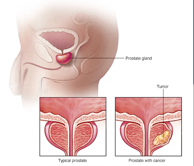 Prostate Cancer medical condition