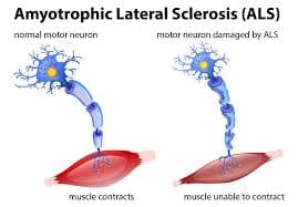 Amyotrophic lateral sclerosis (ALS) medical condition