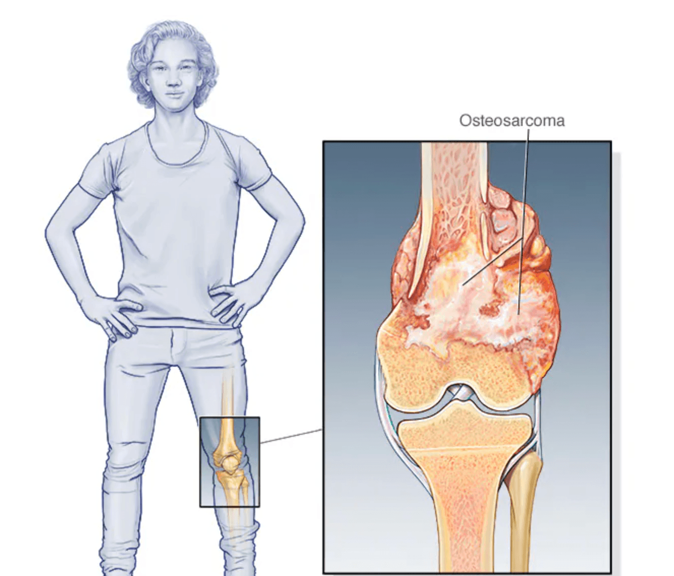 Osteosarcoma medical condition