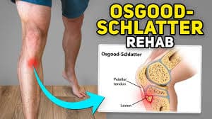 Osgood-Schlatter Disease medical condition