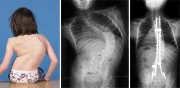 Pediatric Spine Problems medical condition