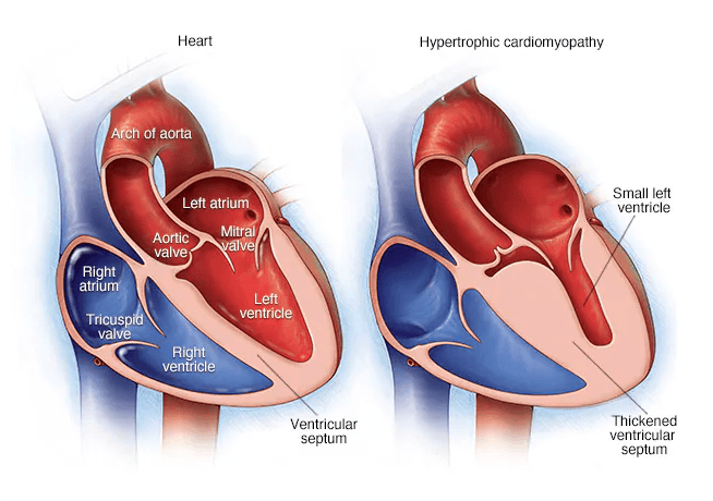 Cardiomyopathy medical condition