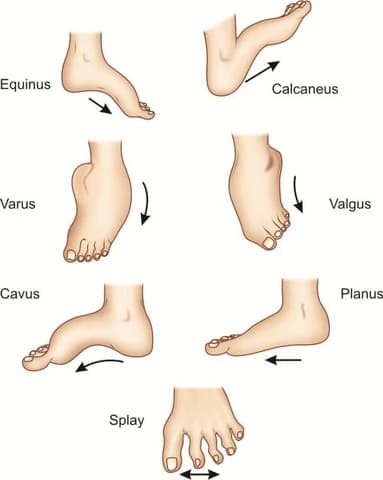 Foot Anomalies medical condition