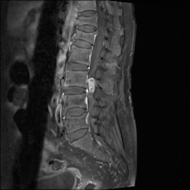 Spinal Neurinoma medical condition