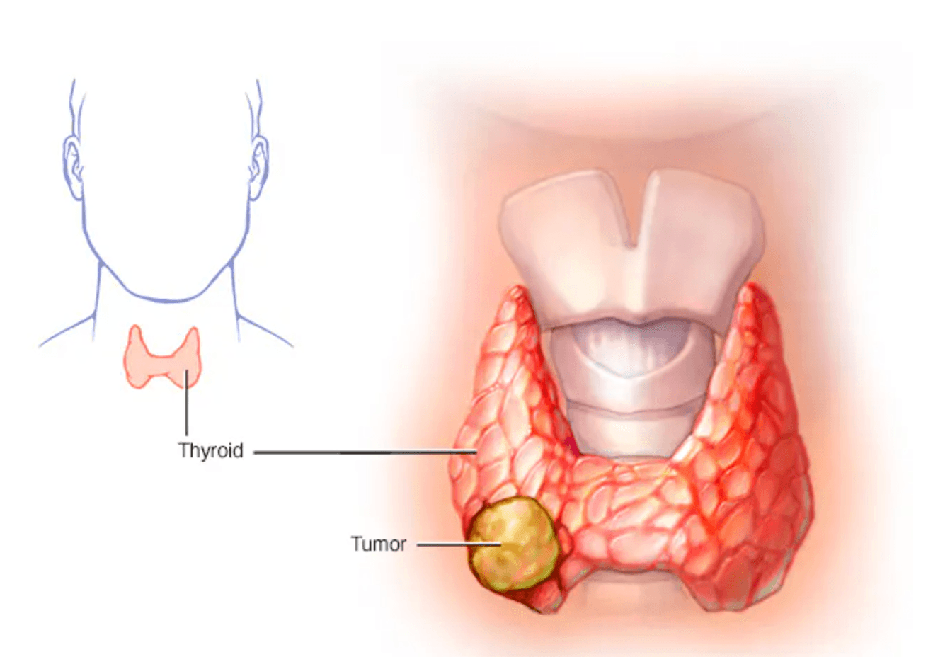 Thyroid Cancer medical condition