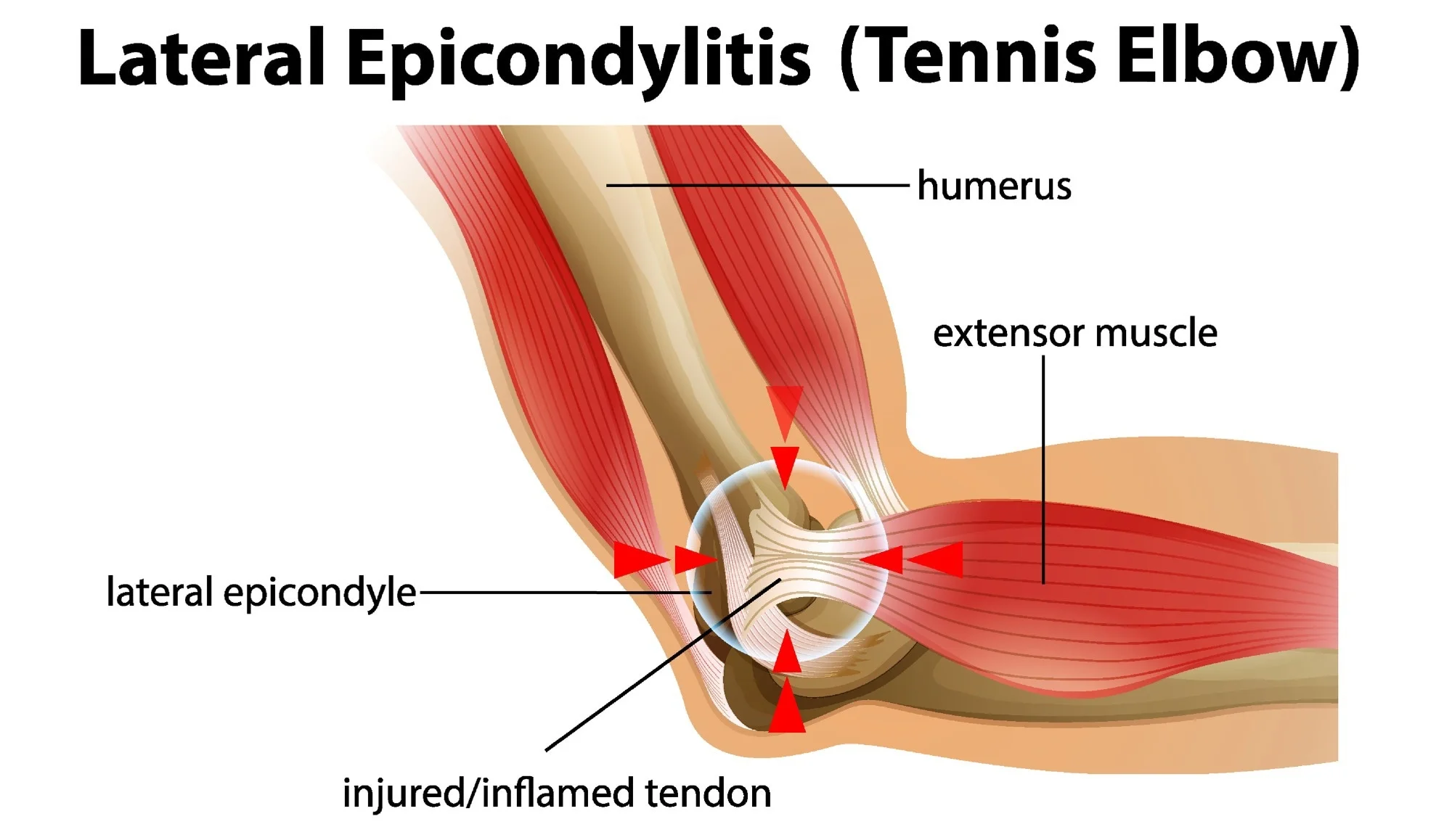 Tennis Elbow (lateral epicondylitis) medical condition