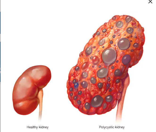 Polycystic Kidney Disease medical condition