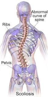 Scoliosis medical condition