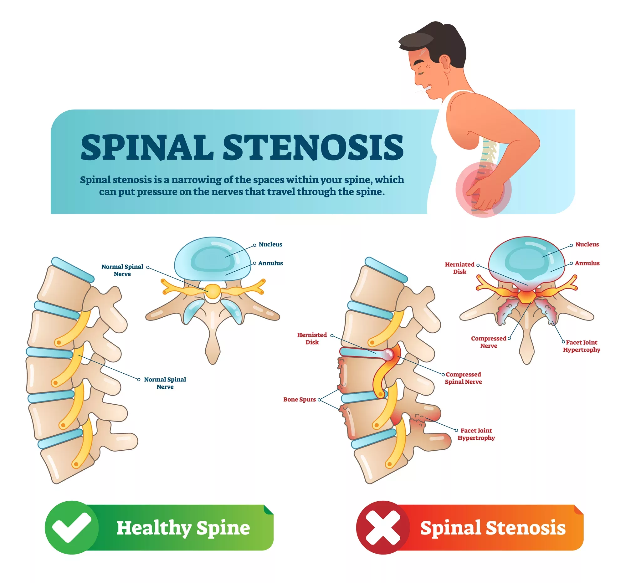 Lumbar spinal stenosis medical condition