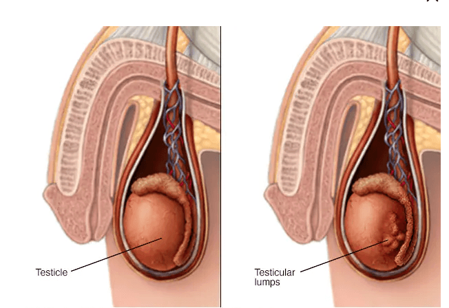 Testicular Cancer medical condition
