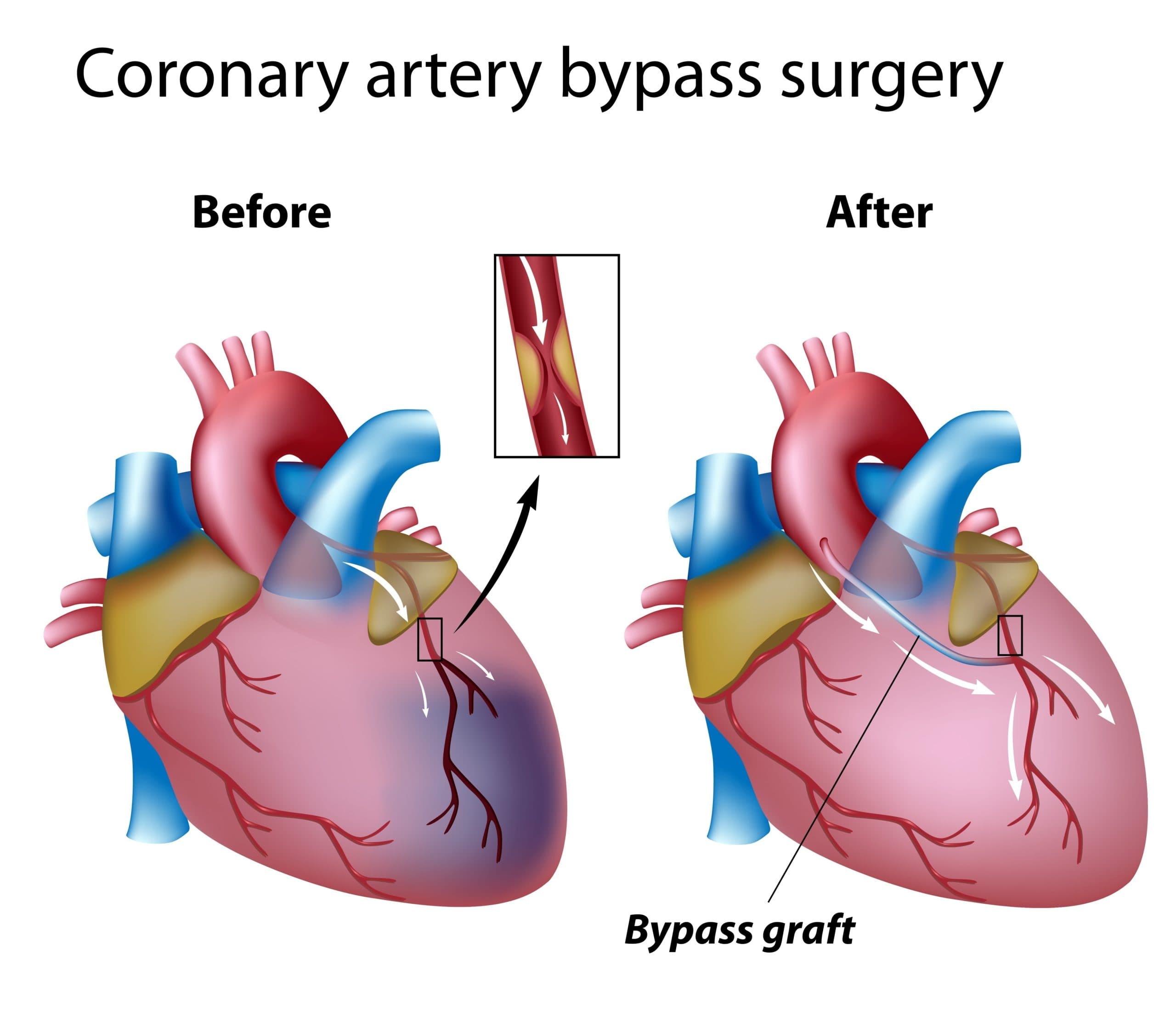 coronary artery bypass graft (CABG) medical condition